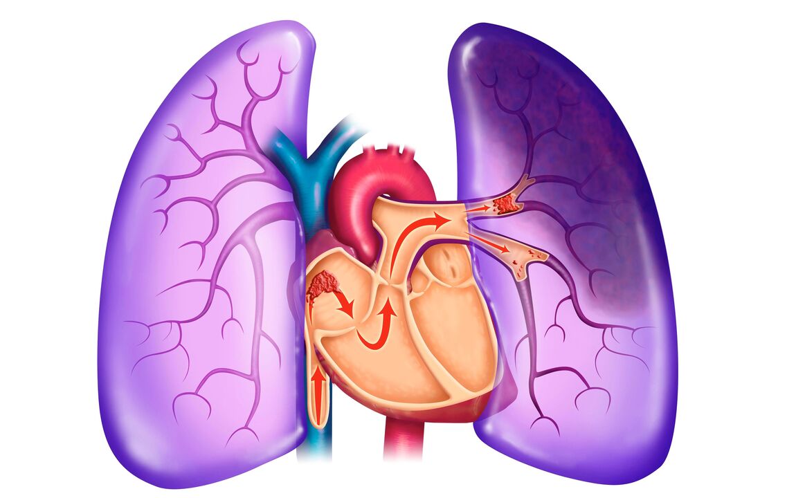 pulmonaalne hüpertensioon